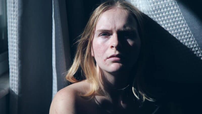 Jak uniknąć blizn po trądziku?