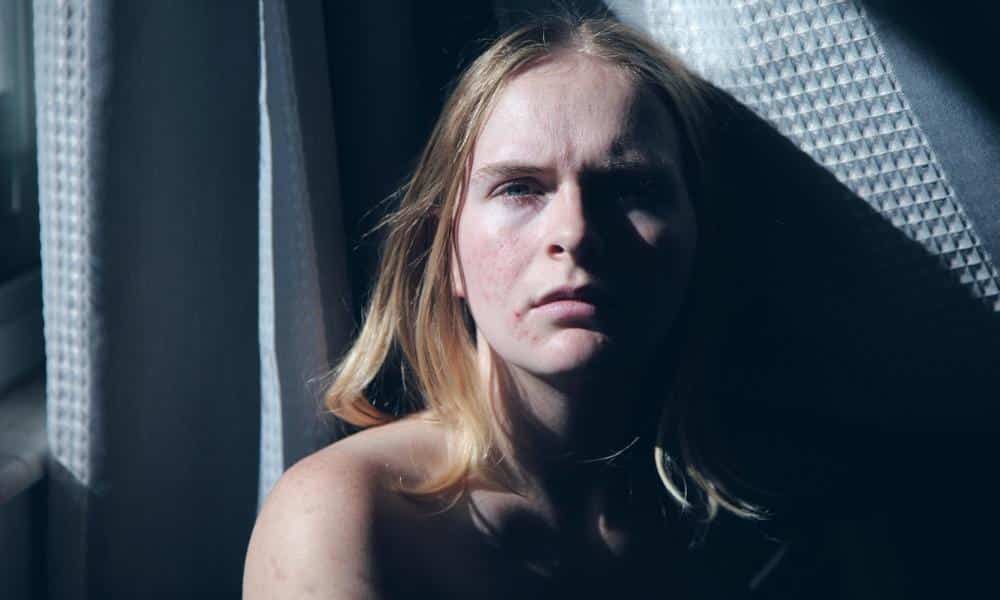 Jak uniknąć blizn po trądziku?